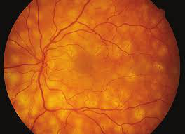 Coriorretinopatia de Birdshot